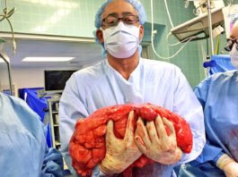 মহিলার পেটে 47 কেজি ওজনের টিউমার ছিল, ডাক্তাররা একটি অলৌকিক ঘটনা ঘটিয়েছিলেন belly tumor