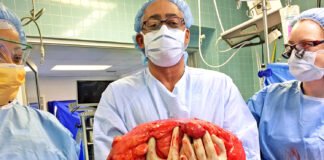 মহিলার পেটে 47 কেজি ওজনের টিউমার ছিল, ডাক্তাররা একটি অলৌকিক ঘটনা ঘটিয়েছিলেন belly tumor