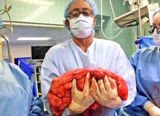 মহিলার পেটে 47 কেজি ওজনের টিউমার ছিল, ডাক্তাররা একটি অলৌকিক ঘটনা ঘটিয়েছিলেন belly tumor