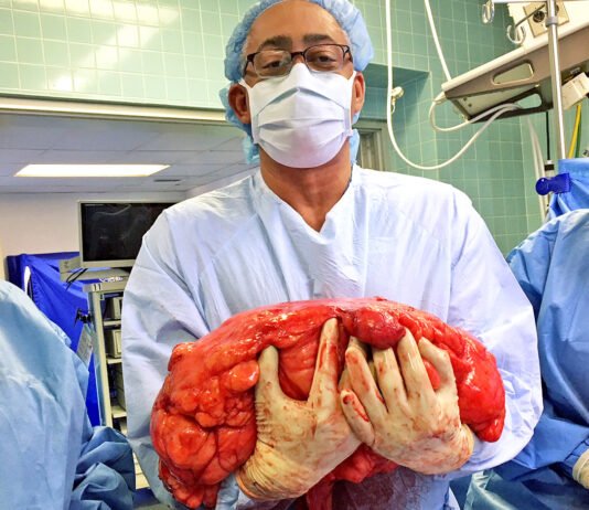 মহিলার পেটে 47 কেজি ওজনের টিউমার ছিল, ডাক্তাররা একটি অলৌকিক ঘটনা ঘটিয়েছিলেন belly tumor