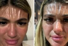 সূর্যালোকে কপাল প্লাস্টিকের মতো সঙ্কুচিত হয়ে যায়!