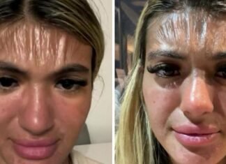 সূর্যালোকে কপাল প্লাস্টিকের মতো সঙ্কুচিত হয়ে যায়!